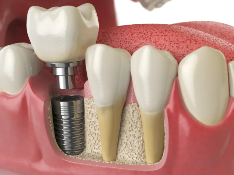 Dental Implants in Oakville ON: Your Path to a Brighter Smile