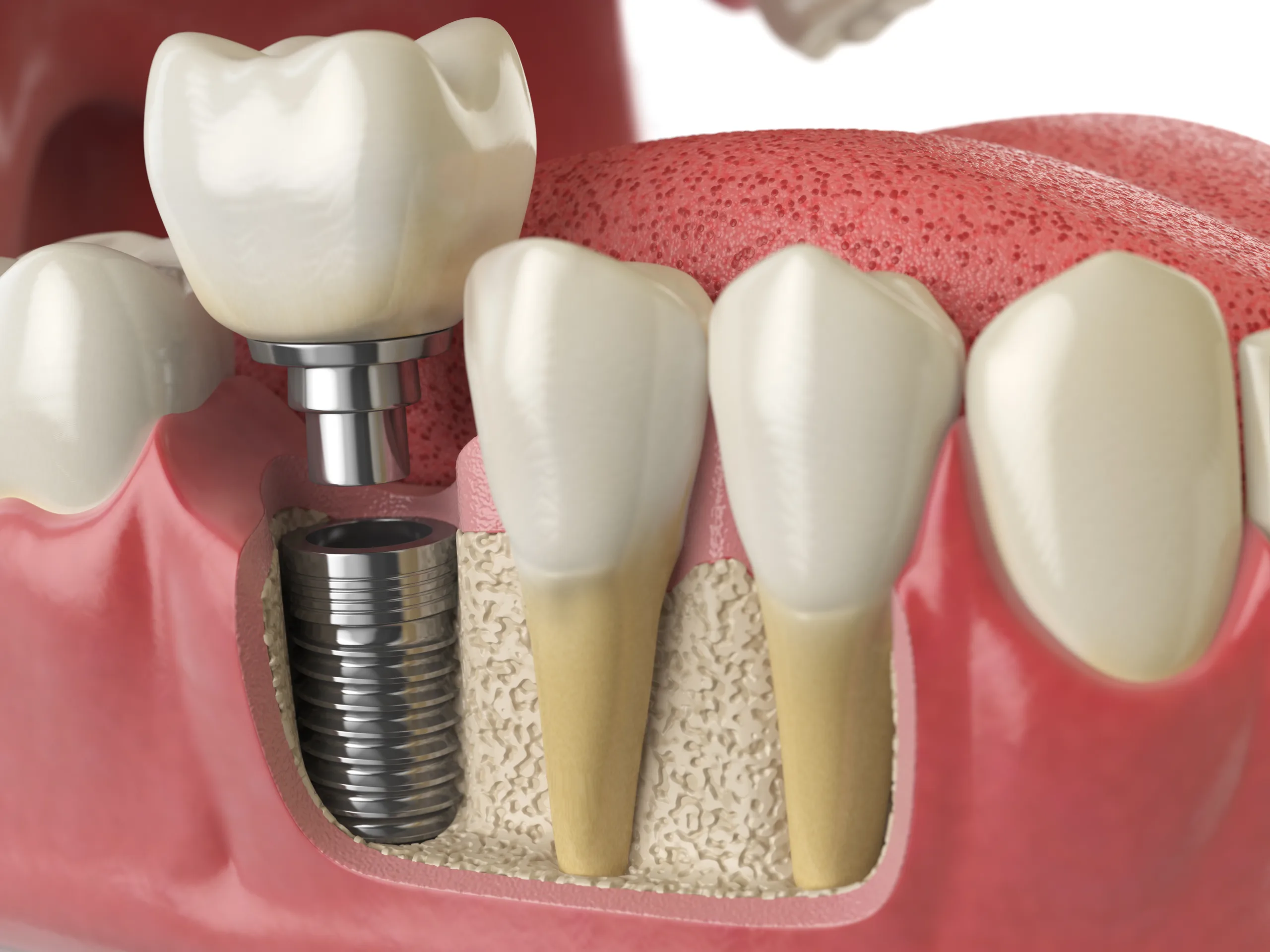 Dental Implants in Oakville ON