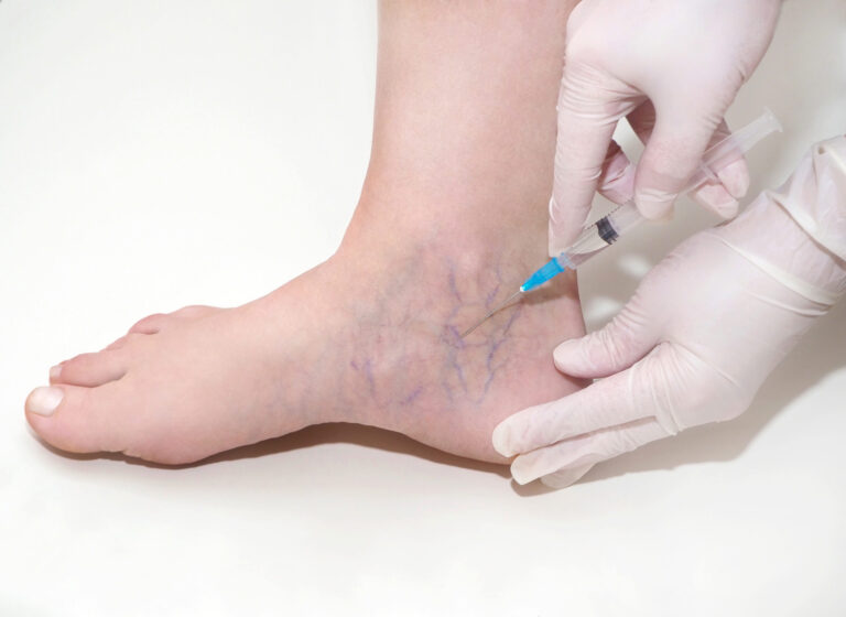 Vein Treatment: A Comprehensive Guide to Effective Vein Care