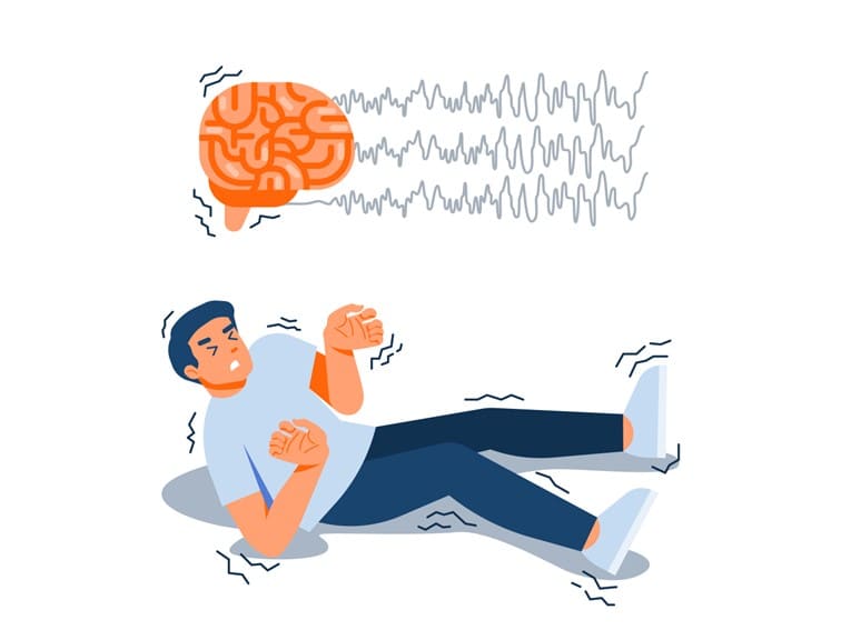 A Comprehensive Guide to Epilepsy and Seizures