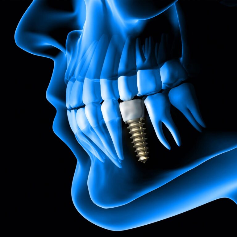 Discovering Excellence: The Best Dental Implant Clinic in Dubai