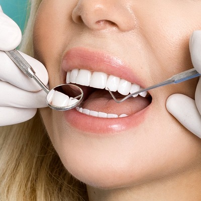 “The Perfect Smile Makeover: A Comprehensive Guide to Dental Veneers”